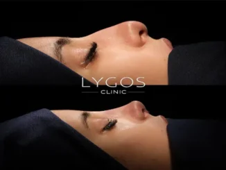 A before-and-after composite image showing the side profile of a person's nose before and after rhinoplasty surgery.