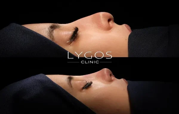 Lygos Clinic Rhinoplasty Before and After A before-and-after composite image showing the side profile of a person's nose before and after rhinoplasty surgery.