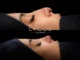 A before-and-after composite image showing the side profile of a person's nose before and after rhinoplasty surgery.