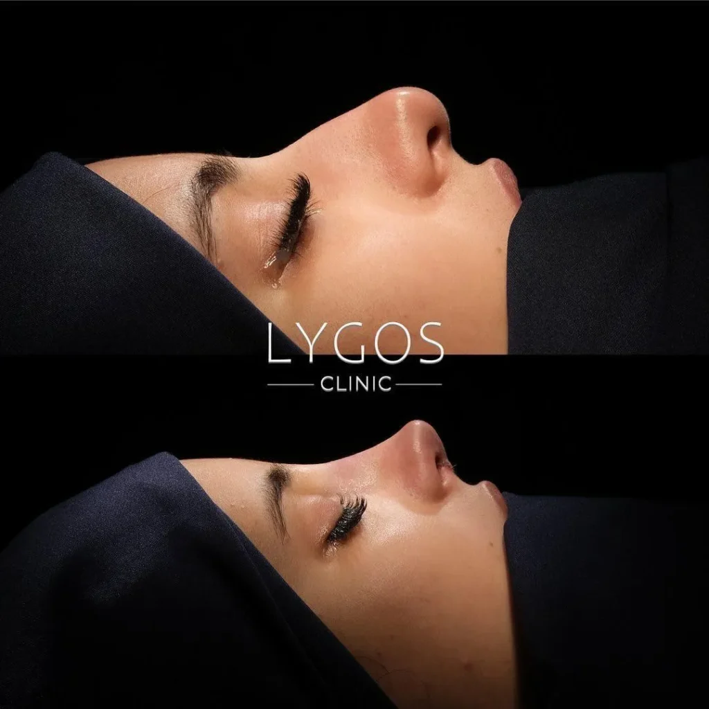 Before and after view of a patient's nose following a rhinoplasty procedure at Lygos Clinic.