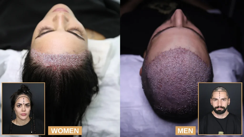 Women’s Hair Transplant vs Men’s Hair Transplant
