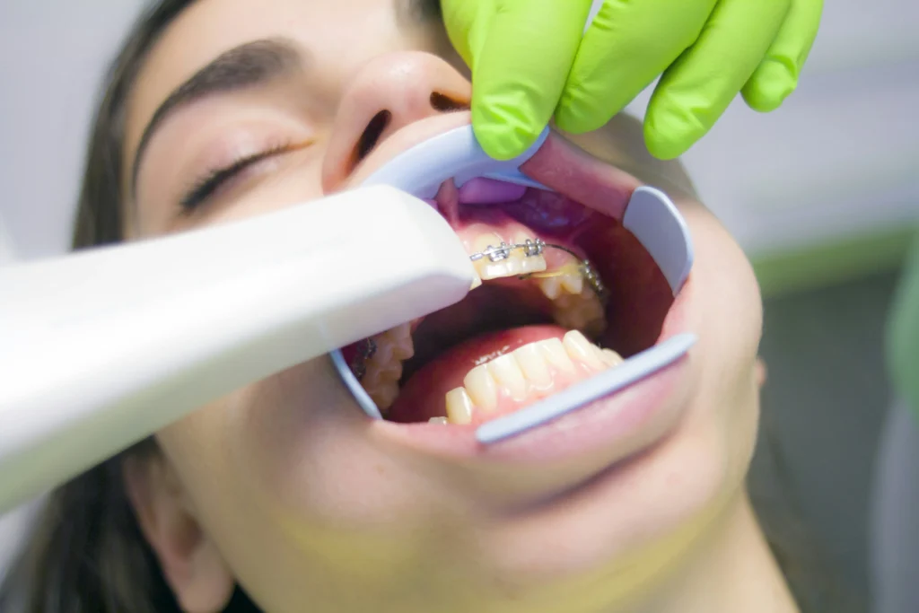 A low-angle close-up of a patient's mouth with a blue cheek retractor exposing teeth with braces, as a gloved hand positions a white dental tool for examination or treatment.