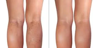 Varicose Vein Treatments
