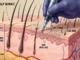 Medical cross-section diagram showing an SMP device depositing pigment dots into the upper dermis layer of the scalp alongside natural hair follicles.